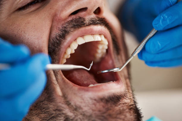 Best Emergency Dentist for Knocked-Out Tooth in Peru, IN